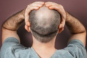 Φαλάκρα: Ποιες θεραπείες λειτουργούν και ποιες όχι