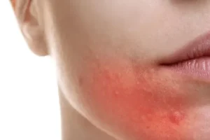 Σε προϊόντα ακμής εντοπίστηκαν ανησυχητικά επίπεδα καρκινογόνου βενζόλιου