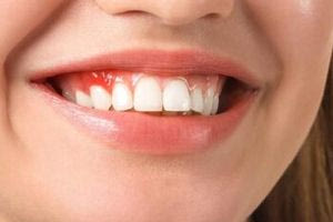 Περιοδοντίτιδα: Ο απρόσμενος σύμμαχος που προφυλάσσει από τη νόσο