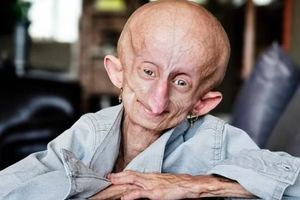 Beandri Booysen: Πέθανε στα 19 το γενναίο κορίτσι που γερνούσε κατά 8 χρόνια σε 12 μήνες