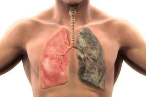 Νέο σύστημα τεχνητής νοημοσύνης ανιχνεύει το 97% των πνευμονοπαθειών