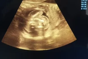 Σπάνιο ιατρικό περιστατικό: Δύο έμβρυα βρέθηκαν στο στομάχι αγέννητου μωρού