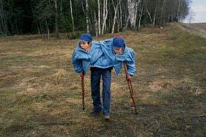 Η τραγική ιστορία των πιο διάσημων σιαμαίων – Από πειραματόζωα των Σοβιετικών στο φριχτό τέλος