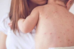 ΠΟΥ: Τα κρούσματα ιλαράς στην Ευρώπη το 2024 έφθασαν στο υψηλότερο επίπεδο των τελευταίων 25 ετών