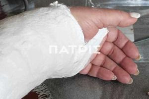 Ηράκλειο: Μία ακόμη γυναίκα τραυματίστηκε στις σχάρες του κέντρου – Θα υποβληθεί σε επέμβαση στο χέρι