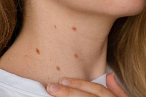 Καρκίνος του δέρματος: Εκστρατεία ενημέρωσης από την ΕΔΑΕ με δωρεάν εξετάσεις