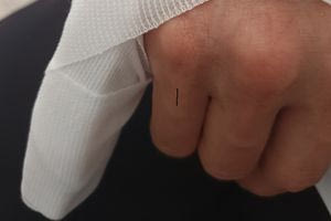 Ο  σεισμός έφερε και… κατάγματα – Αρκετές περιπτώσεις πολιτών που τραυματίστηκαν από το φόβο τους