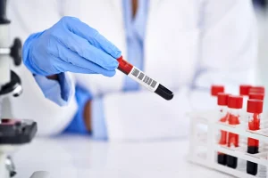 ΗΠΑ: Πράσινο φως για το πρώτο τεστ διάγνωσης του Αλτσχάιμερ με μια απλή εξέταση αίματος