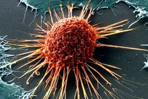 Το σύμπτωμα του καρκίνου που μπορείτε να εντοπίσετε μόνο τη νύχτα