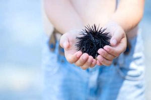 Tι να κάνετε αν σας τσιμπήσει αχινός, δράκαινα ή σκορπίνα