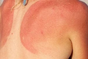 Ηλιακό έγκαυμα και πονοκέφαλος από τον ήλιο: Τι να κάνετε για να απαλλαγείται σύντομα