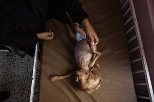 Τραγικές μαρτυρίες από τη Γάζα: Υποσιτισμένα παιδιά φτάνουν καθημερινά στο νοσοκομείο