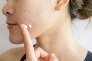 Γιατί δεν πρέπει να βάζουμε οδοντόκρεμα σε ένα σπυράκι;