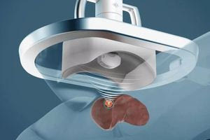 Ρομπότ στις ΗΠΑ καταστρέφει τον καρκίνο με υπέρηχο – Η θεραπεία γίνεται χωρίς κανένα άνοιγμα του κορμιού