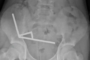 Νέα Ζηλανδία :Δεκάδες μαγνήτες από τα έντερα 13χρονου αφαίρεσαν γιατροί