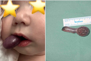 ΠΑΓΝΗ: Βρέφος τριών μηνών με σπάνια πάθηση του φάρυγγα έσωσαν οι γιατροί