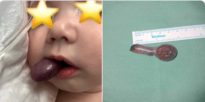 ΠΑΓΝΗ: Βρέφος τριών μηνών με σπάνια πάθηση του φάρυγγα έσωσαν οι γιατροί