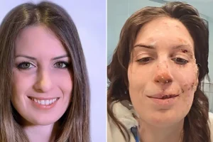 «Η ψυχή χρειάζεται περισσότερο χρόνο για να επουλωθεί»: Εξιτήριο για 29χρονη μετά τη φωτιά στο Κραν Μοντανά, ο μακρύς δρόμος της αποκατάστασης