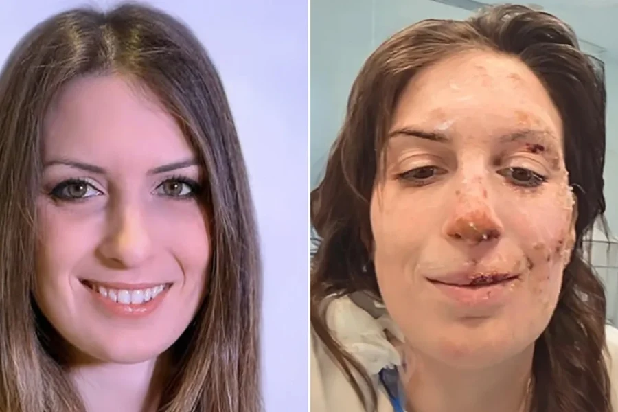 «Η ψυχή χρειάζεται περισσότερο χρόνο για να επουλωθεί»: Εξιτήριο για 29χρονη μετά τη φωτιά στο Κραν Μοντανά, ο μακρύς δρόμος της αποκατάστασης