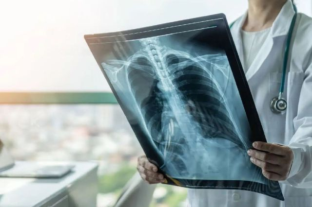 400 κρούσματα φυματίωσης στην Ελλάδα – Το 80% σύμφωνα με την επίκουρη καθηγήτρια Πνευμονολογίας είχαν πνευμονική φυματίωση