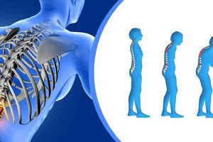 Ποια φάρμακα για την οστεοπόρωση μειώνουν τον κίνδυνο άνοιας – Έρευνα αποκαλύπτει