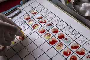 Υψηλότερα επίπεδα βιταμίνης D στο αίμα μπορεί να συνδέονται με χαμηλότερο κίνδυνο Αλτσχάιμερ