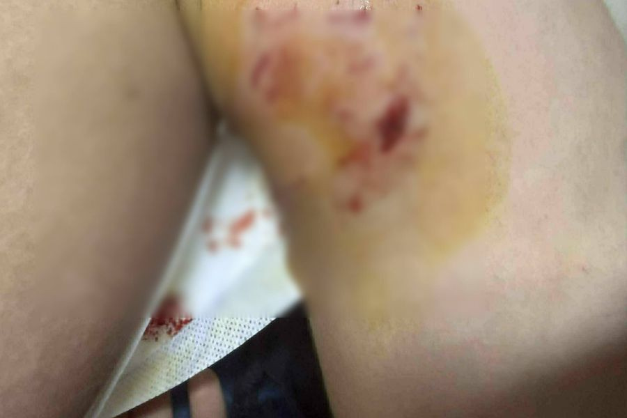 (ΦΩΤΟ) Άγρια επίθεση σκυλιού σε παιδί κοντά σε Γυμνάσιο στη Μεσαρά