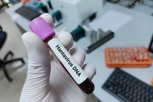Χανταϊός: Διαφορετικά τα συμπτώματα του ιού στην Ελλάδα – «Βγάζεις μελανιές»
