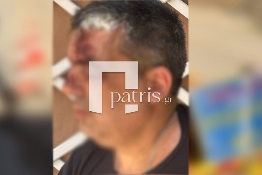(ΦΩΤΟ&ΒΙΝΤΕΟ) Με σοβαρά τραύματα ο δικυκλιστής που έπεσε σε λακκούβα στο Ηράκλειο – Ετοιμάζει μηνύσεις για το σημείο-παγίδα