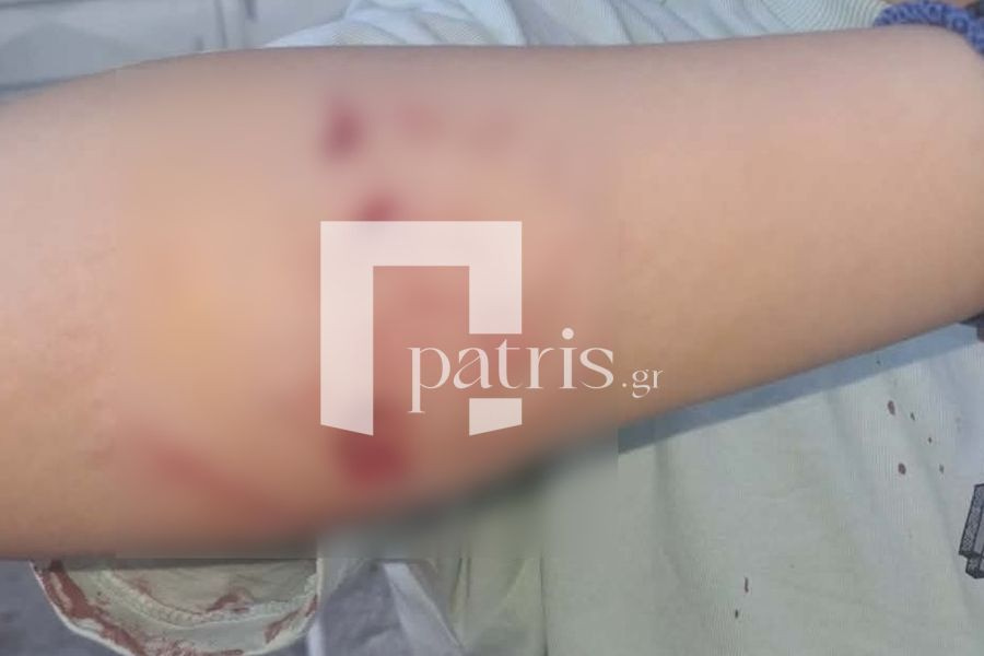 Έζησε τον εφιάλτη στα δόντια σκύλου – Σοκάρουν οι φωτογραφίες του 9χρονου παιδιού που δέχθηκε επίθεση από το λυκόσκυλο του γείτονα