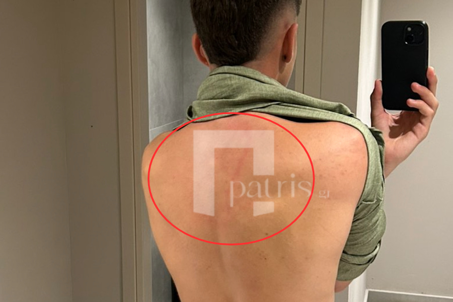 Μαρτυρία 16χρονου ξενοδοχοϋπαλλήλου στο patris.gr: “Ήθελα μόνο να ξεκουραστώ και με χτύπησε…” – Το θύμα αποκαλύπτει όσα υπέστη από τον Διευθυντή του ξενοδοχείου στη Χερσόνησο (pics)