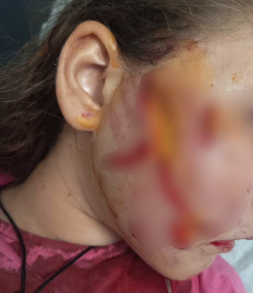 Ηράκλειο: Στο νοσοκομείο επτάχρονο κοριτσάκι μετά από επίθεση σκύλου